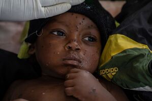 Ein an Mpox erkrankter zweijähriger Junge liegt in einem Krankenhaus in Kamituga im Osten des Kongo., © Moses Sawasawa/AP